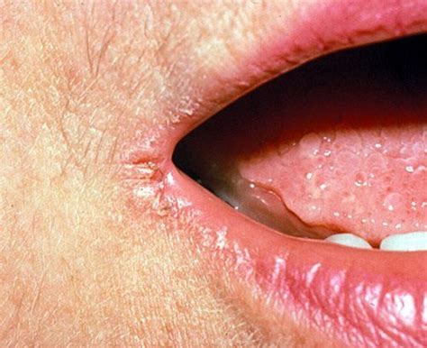 10 Best Home Remedies For Angular Cheilitis Mouth Sores Cracked Corners Of Mouth Sore In