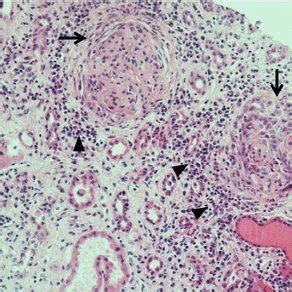 A Renal Biopsy Specimen Shows Two Glomeruli With Fibrocellular