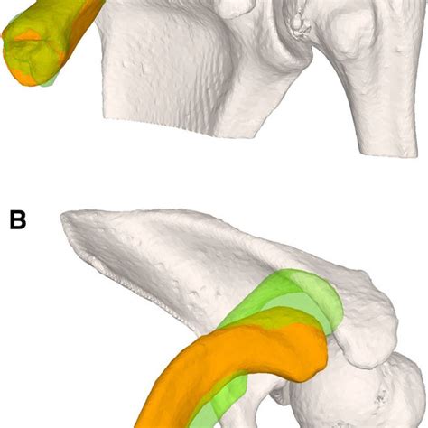 A Case 3 With Re Fractured Clavicle Malunion B Preoperative Plan With