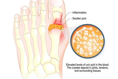 Understanding And Managing Gout A Comprehensive Guide Facty Health