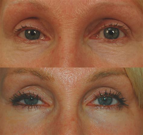 Laser Resurfacing For The Eyes