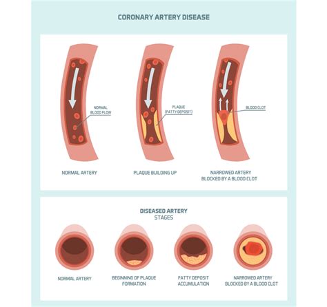 What does a heart attack feel like: symptoms and warning signs • HRI