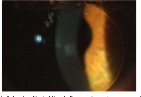 Figure 1 From Evaluation Of Simultaneous Topography Guided Prk And