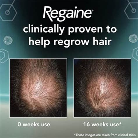 Rogaine Regaine® For Men Extra Strength Scalp Foam Glamitup Pk