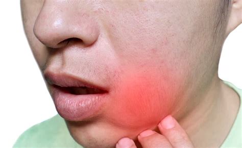 Abscesses And Swollen Jaw Emergency Dental Services Houston