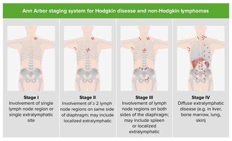 Linfomas No Hodgkin Concise Medical Knowledge