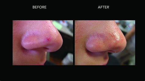 Rosacea Treatment Kelowna Facial Redness