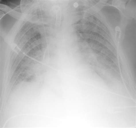 Pulmonary Edema Chest X Ray