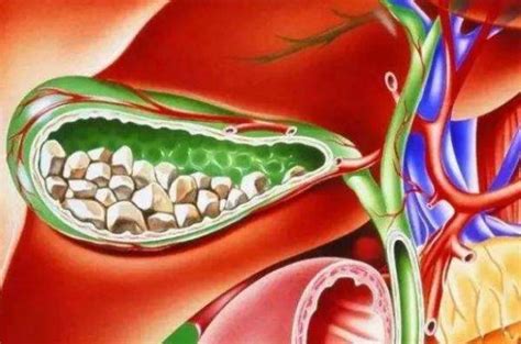 胆结石是怎样形成的呢有没有必要手术摘除呢 胆囊 患者 早餐