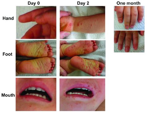 Photographs Of A Patient With The Hfmd Caused By Cv A6 Day 0 And 2