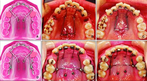 The Occlusal Diagrams And Intraoral Photos A C The C Lingual