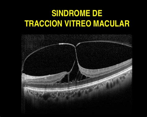 Tracción Vítreo Macular Somos Retina y Mácula Consultores