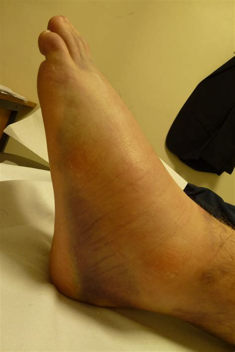 High Ankle Sprain Swelling