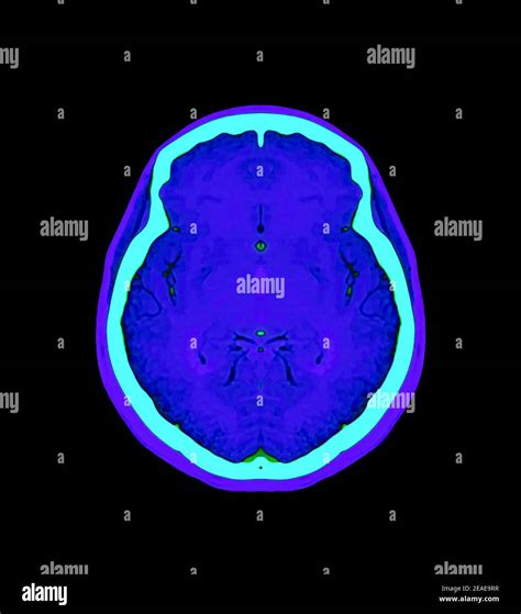 Colorful Of CT Angiography Of The Brain Or CTA Brain Axial Coronal