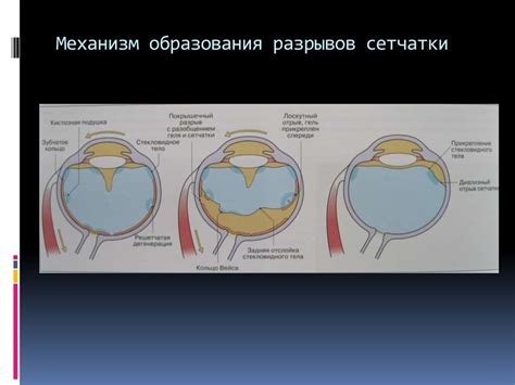 Заболевания сетчатки и зрительного нерва - презентация онлайн