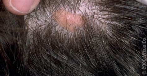 What is Nevus Sebaceous? - Children's Dermatology