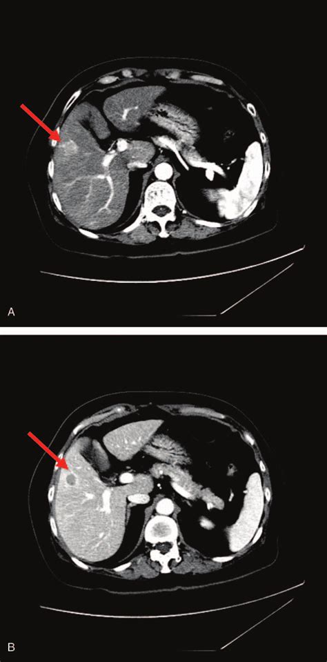 Computed Tomography Of The Liver Showing An Enhanced Nodule A With