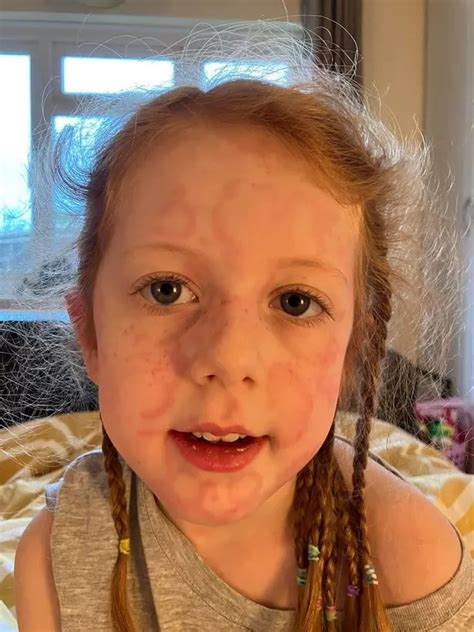 Bite From Britains Most Dangerous Spider Left Girl 5 Unable To Walk And Covered In Rashes