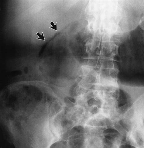 Gallstones Xray