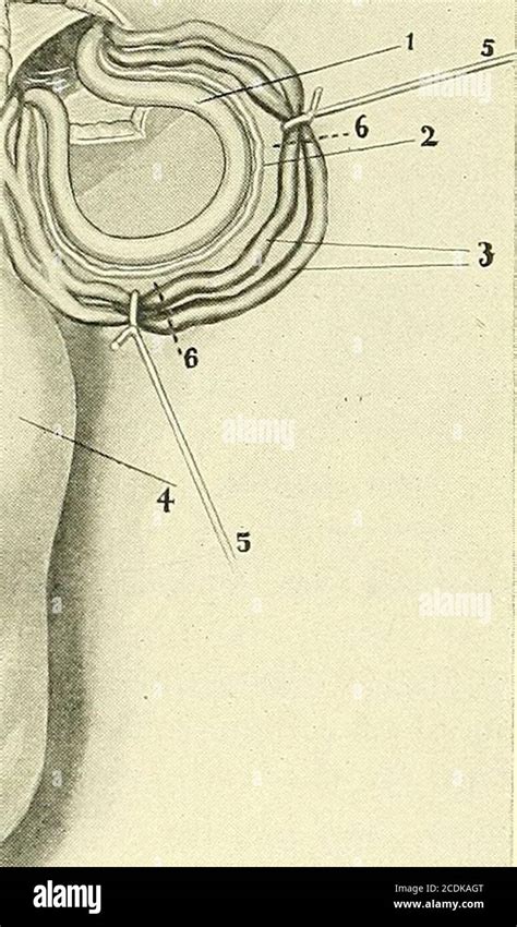 Surgery Its Principles And Practice Fig 333 —varicocele Operation