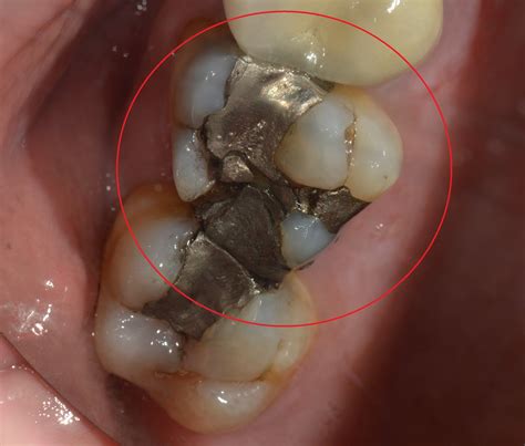 A BLOG ABOUT LIFE AND DENTISTRY: Cracked Amalgam Fillings