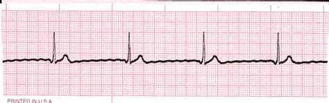 Junctional Rhythm - EKG Lesson #314