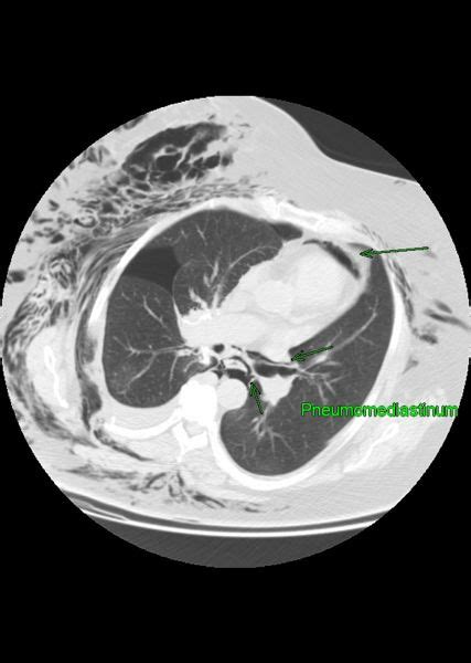 Pneumomediastinum Ct Wikidoc