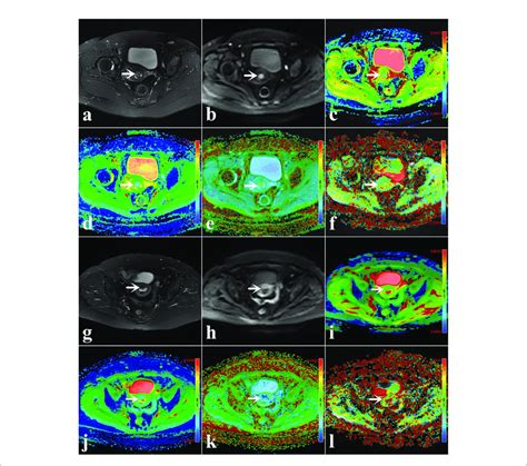 A F A 48 Year Old Woman With Low Risk Endometrial Cancer Ec Download Scientific Diagram