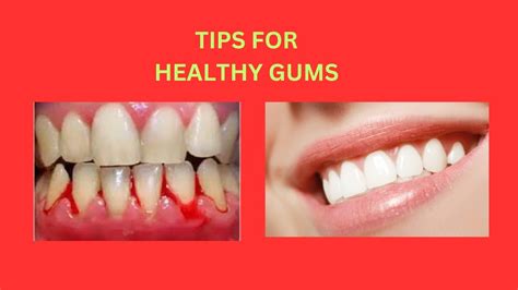 Gum Health 101 Tips For Healthy Gums Youtube