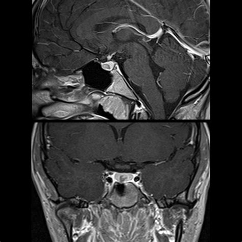 Pituitary Gland Mri