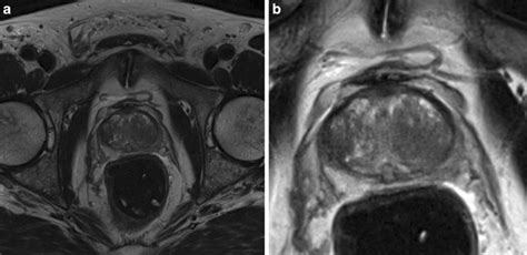 Axial T2 Weighted Image A Before And B After Preprocessing