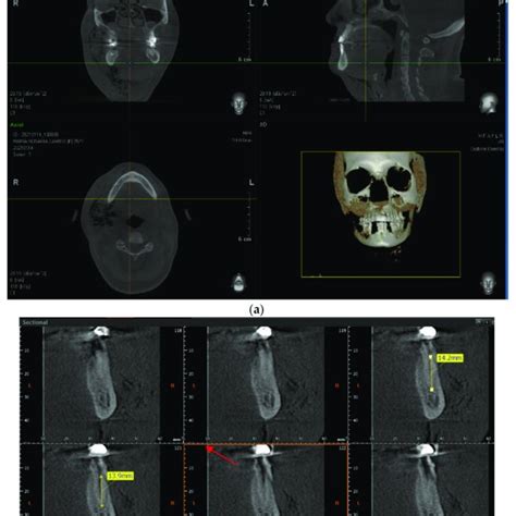 Cone Beam Computed Tomography Cbct Images A Air Infiltration Is Download Scientific