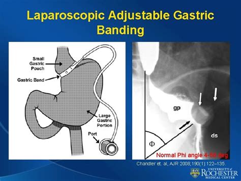 Imaging Of Bariatric Surgery Normal Anatomy And Postoperative