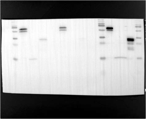 Two Patients With Congenital Myasthenic Syndrome Caused By Colq Gene