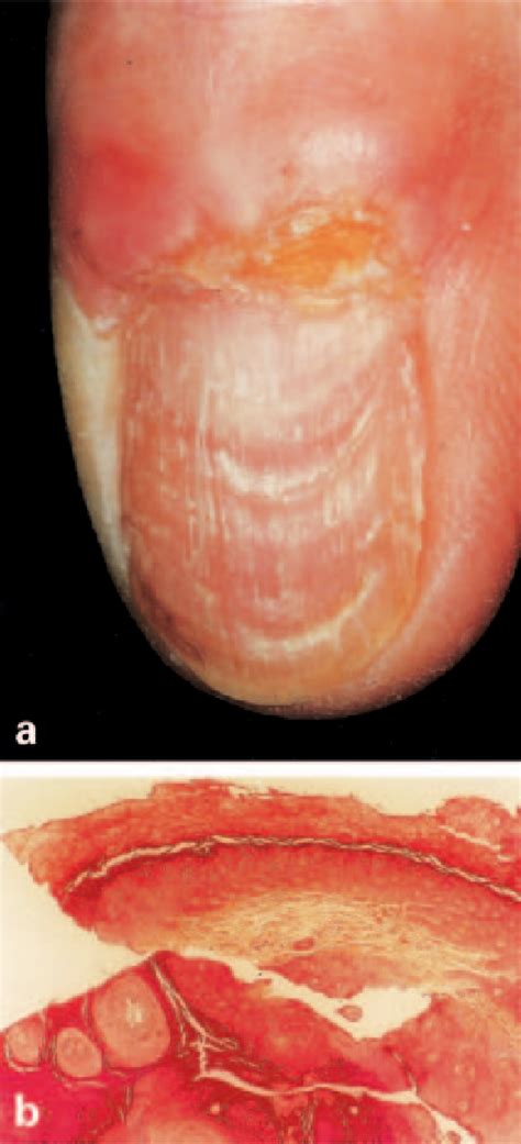 Figure 1 From Periungual Keratoacanthoma Preceded By A Wart And