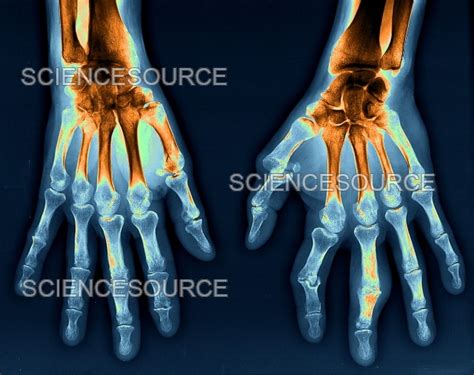 Rheumatoid arthritis, x-ray | Stock Image - Science Source Images