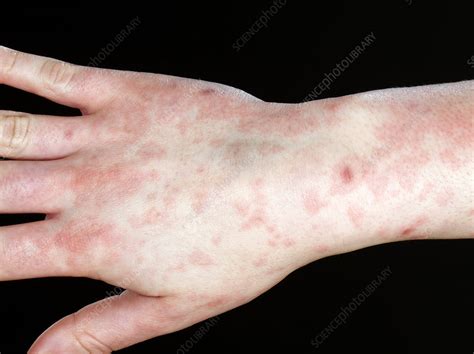 Mononucleosis Rash