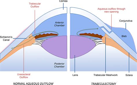 Aqueous Outflow In A Normal Eye Left Vs Following Trabeculectomy