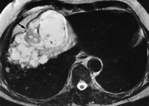 Imaging Of Atypical Hemangiomas Of The Liver With Pathologic Correlation Radiographics