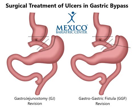 Signs And Symptoms Of Ulcers After Gastric Bypass Mexico Bariatric Center