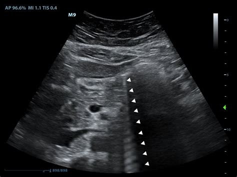 Sonoguide Ultrasound Physics And Technical Facts For The Beginner