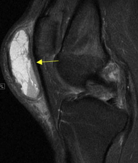 Prepatellar Bursitis Mri