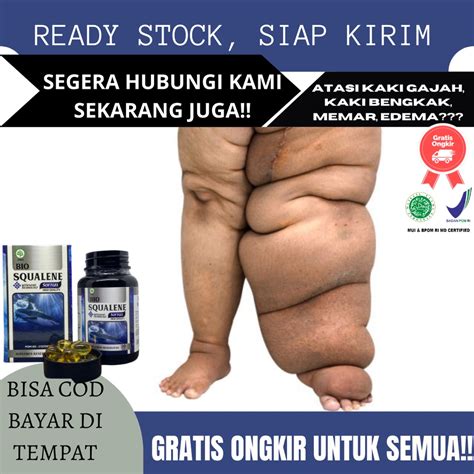 Jual Obat Kaki Gajah Bengkak Obat Penyakit Kaki Gajah Filariasis