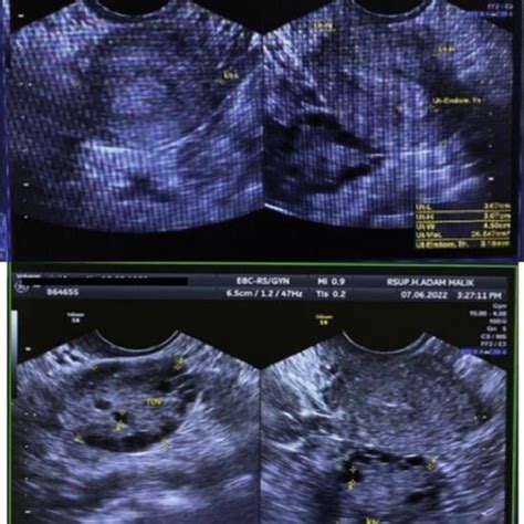 Ultrasound Examination Concluded Polycystic Ovary Syndrome Pcos