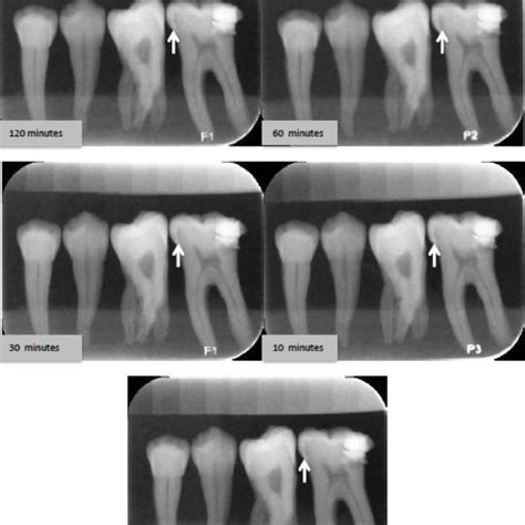 Pdf Diagnosis Of Approximal Caries After Delayed Scanning Of