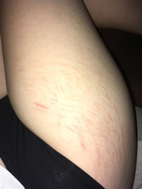 Self Harm Scar Hiding Glow Community