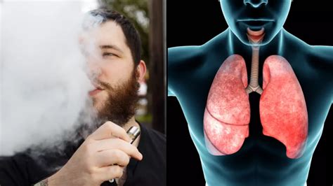 Expert Warns Vape Users Of Serious Risk Of Popcorn Lung That Can Be Fatal - News - LADbible