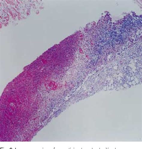 Figure From Hemophagocytic Syndrome Associated With Kikuchi S Disease