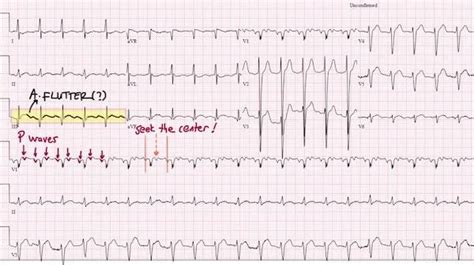 Atrial Flutter Symptoms Causes Treatment