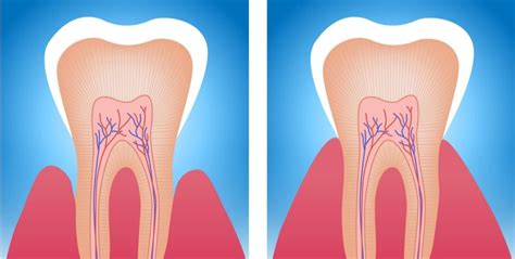 Pr Venir La Sensibilit Dentaire Rh Ne Dental Clinic